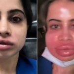 Uorfi Javed's Lip Filler Removal Goes Painfully Wrong