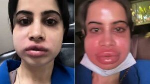 Uorfi Javed's Lip Filler Removal Goes Painfully Wrong
