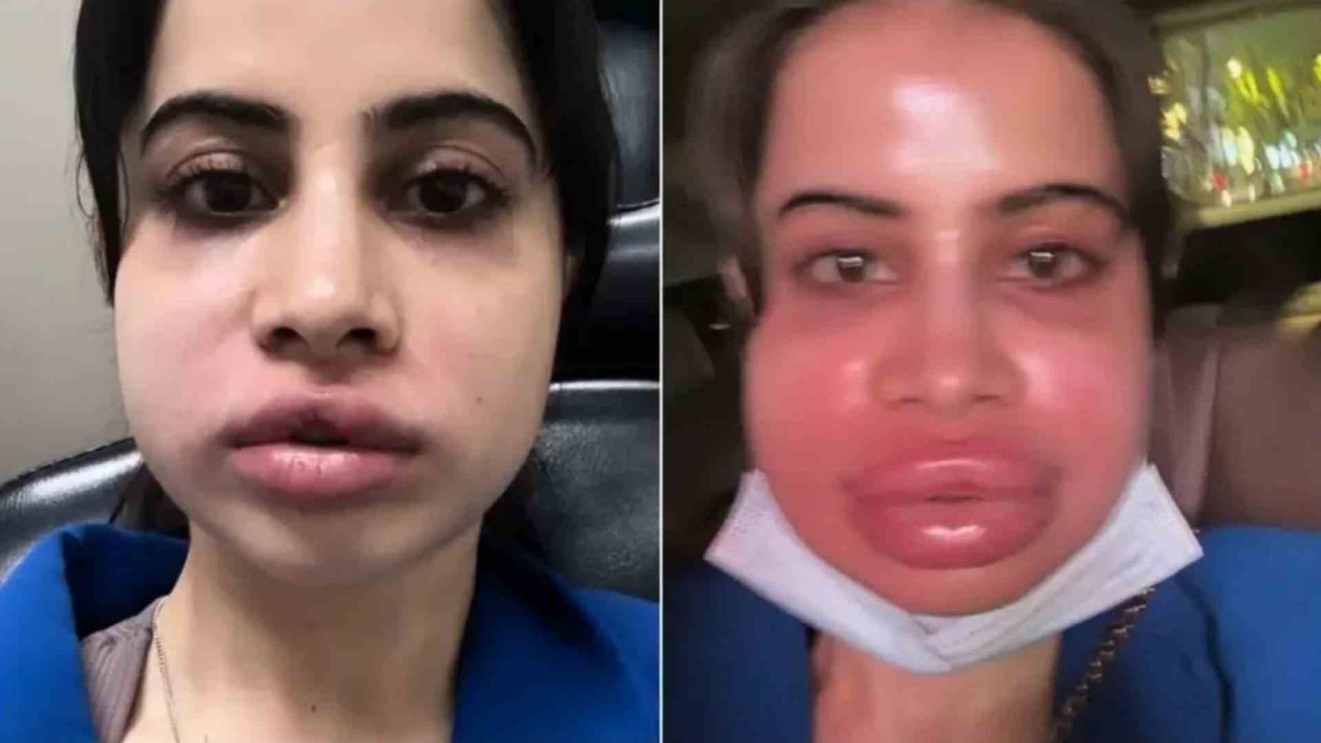 Uorfi Javed's Lip Filler Removal Goes Painfully Wrong